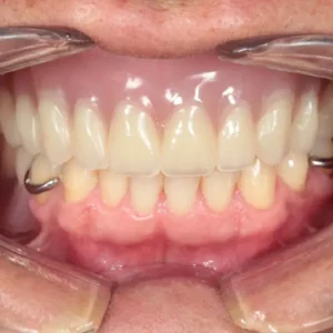 Despues, Antes y después de una rehabilitación oral
