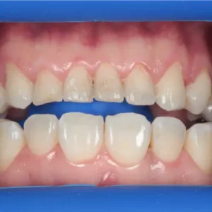 Antes, Antes y después de una rehabilitación oral