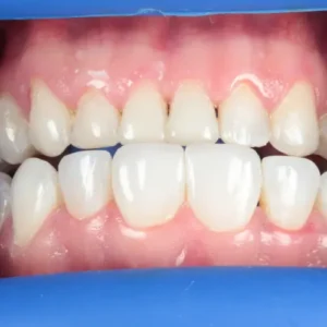 Despues, Antes y después de una rehabilitación oral