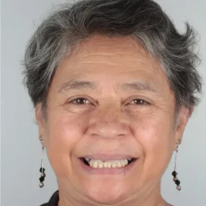 Antes, Antes y después de una rehabilitación oral